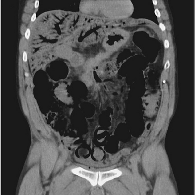 This Woman S Umbilical Nodule Bled Intermittently What Is The Most Likely Diagnosis ~ Medical